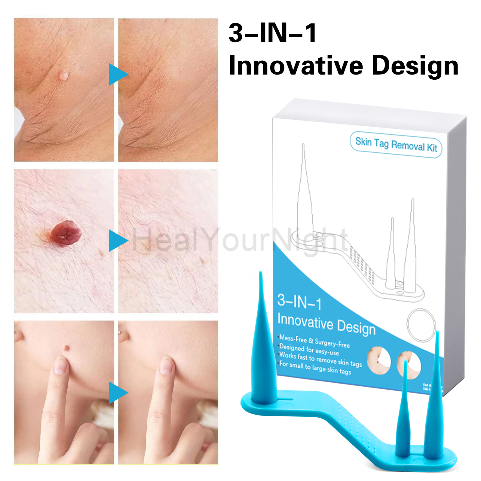 3-IN-1 Auto Skin Tag Removal K – обзор и цена Acne Light Therapy Pen
