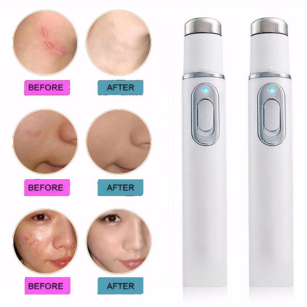 Blue Light Therapy Acne Pen LE – обзор и цена Acne Light Therapy Pen