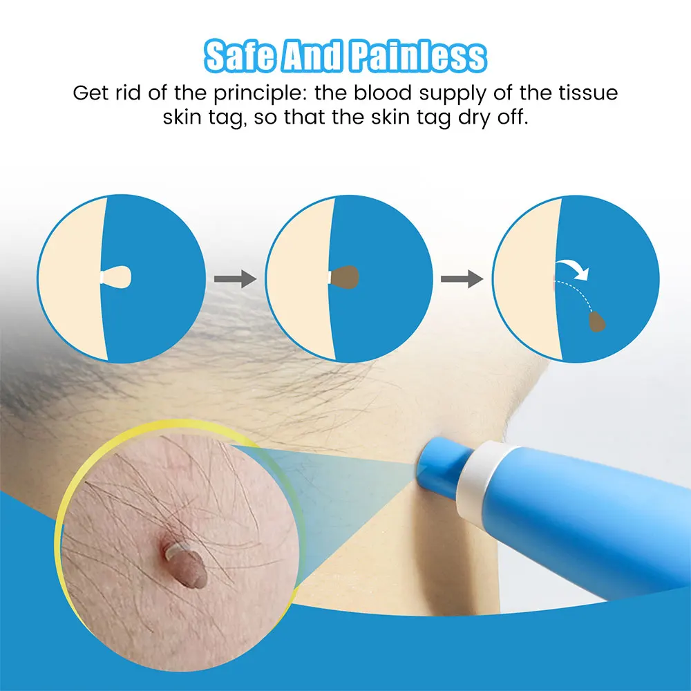 Auto Skin Tag Removal Tool Kit – обзор и цена Acne Light Therapy Pen